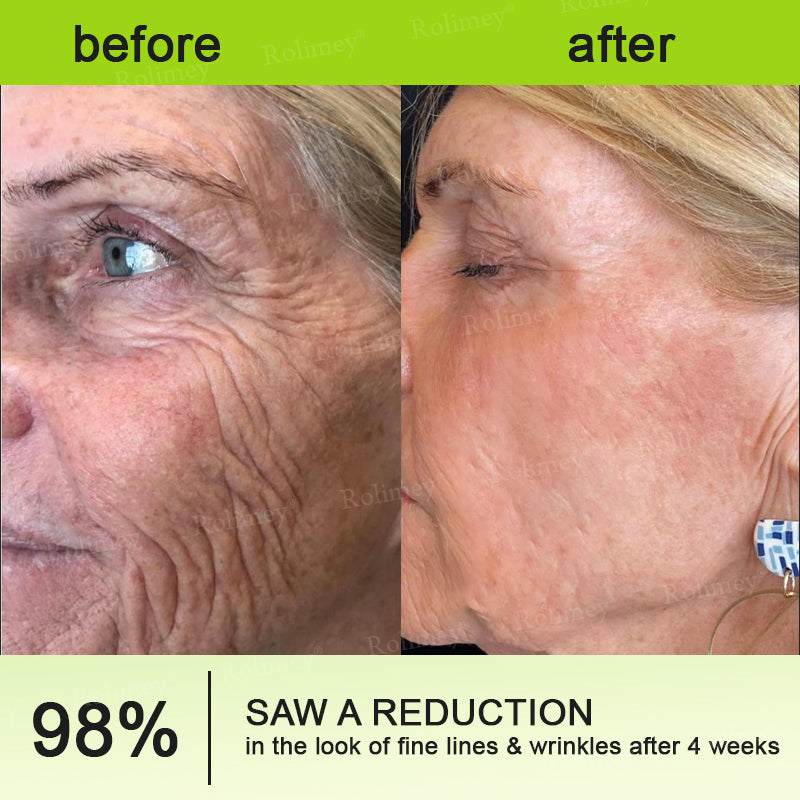 👨‍⚕️Made and shipped from Australia💫 Botox & Vita-A Retinol Shot Wrinkle-Lift Tightening cream - Last Day Promotion 70% OFF